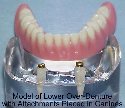 model of dentures, Frederick MD